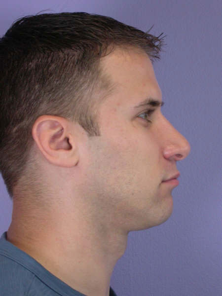 Nose Reshaping before and after photo