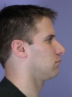 Nose Reshaping Before and after photo