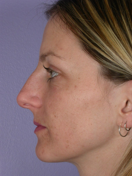 Nose Reshaping before and after photo