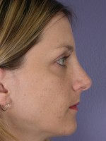 Nose Reshaping Before and after photo