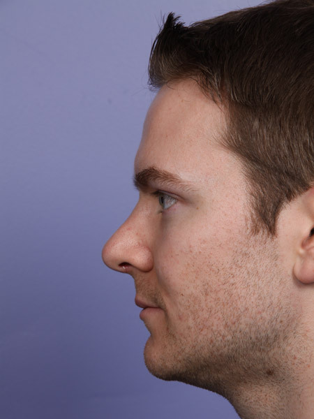 Nose Reshaping before and after photo