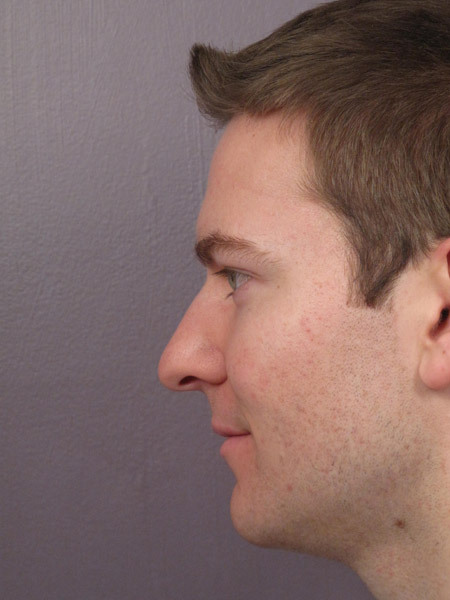 Nose Reshaping before and after photo