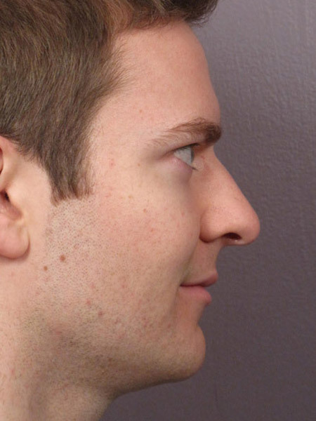 Nose Reshaping before and after photo