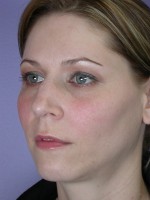 Nose Reshaping Before and after photo