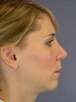 Nose Reshaping Before and after photo