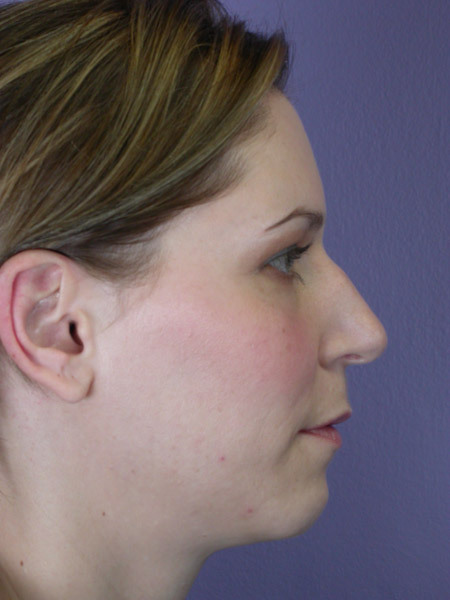 Nose Reshaping before and after photo