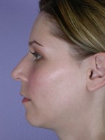 Nose Reshaping Before and after photo