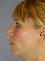 Nose Reshaping Before and after photo