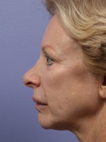 Nose Reshaping Before and after photo