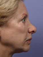 Nose Reshaping Before and after photo