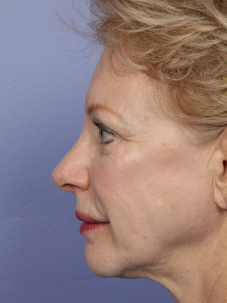 Nose Reshaping before and after photo