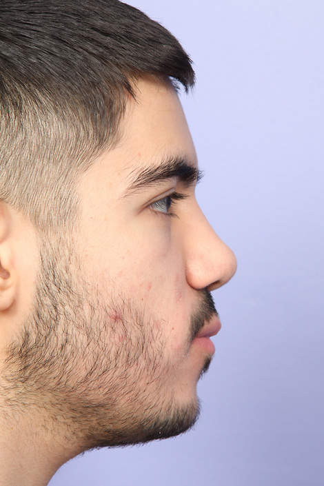 Nose Reshaping before and after photo