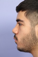 Nose Reshaping Before and after photo