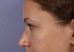 Nose Reshaping Before and after photo