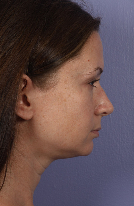 Nose Reshaping before and after photo