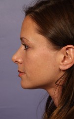 Nose Reshaping Before and after photo