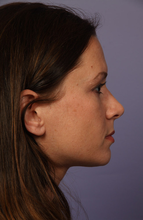 Nose Reshaping before and after photo