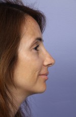 Nose Reshaping Before and after photo