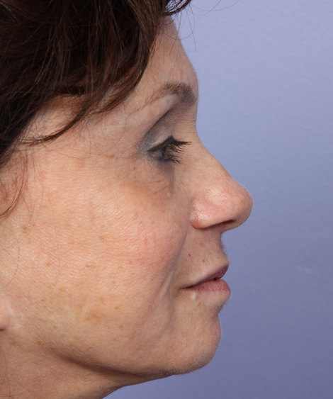 Nose Reshaping before and after photo