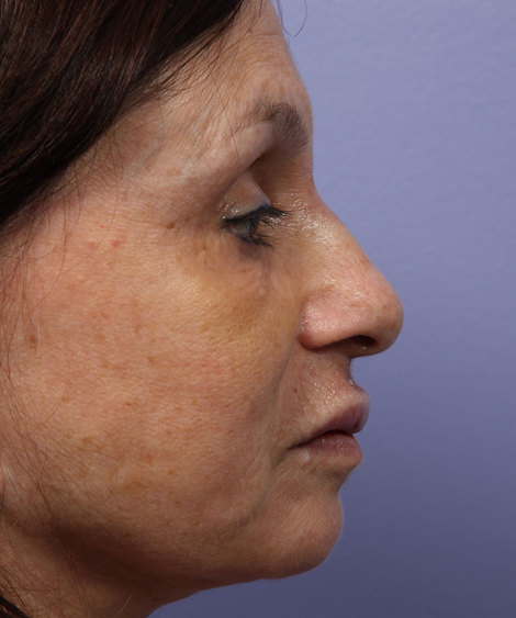 Nose Reshaping before and after photo