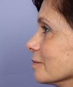 Nose Reshaping Before and after photo