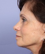 Nose Reshaping Before and after photo