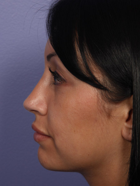 Nose Reshaping before and after photo