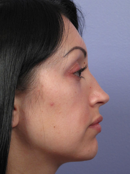 Nose Reshaping before and after photo