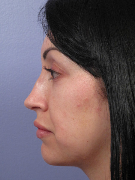 Nose Reshaping before and after photo