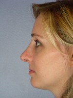 Nose Reshaping Before and after photo