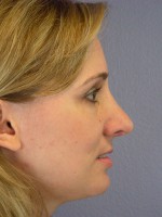 Nose Reshaping Before and after photo