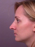 Nose Reshaping Before and after photo