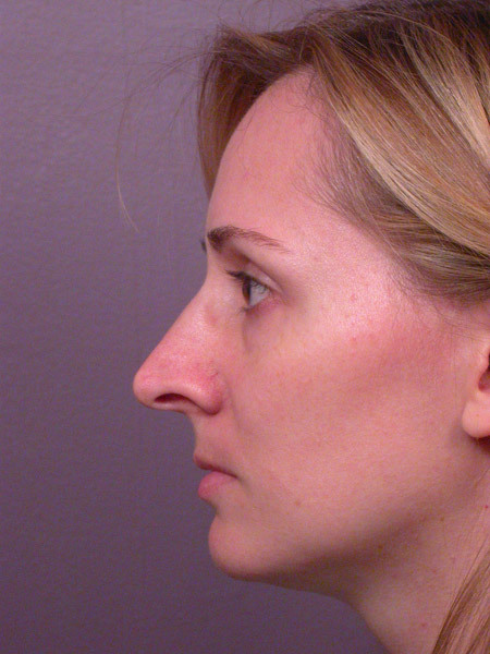 Nose Reshaping before and after photo