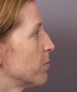 Nose Reshaping Before and after photo