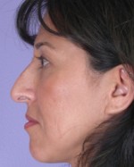 Nose Reshaping Before and after photo