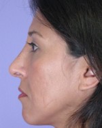 Nose Reshaping Before and after photo