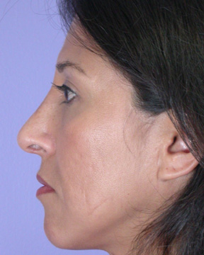 Nose Reshaping before and after photo