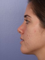 Nose Reshaping Before and after photo