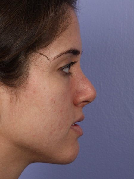 Nose Reshaping before and after photo