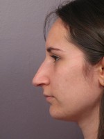 Nose Reshaping Before and after photo