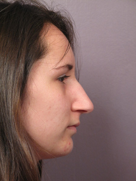 Nose Reshaping before and after photo