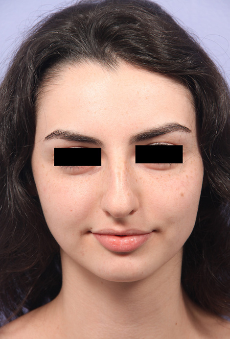 Nose Reshaping before and after photo