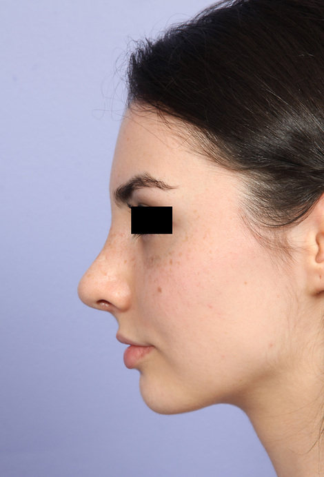 Nose Reshaping before and after photo