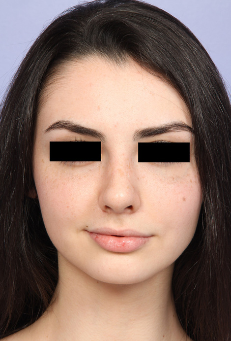 Nose Reshaping before and after photo