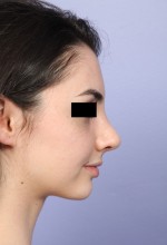 Nose Reshaping Before and after photo