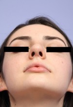 Nose Reshaping Before and after photo