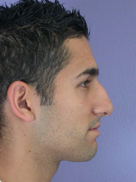 Nose Reshaping before and after photo