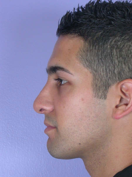 Nose Reshaping before and after photo