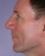 Nose Reshaping Before and after photo