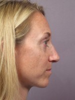 Nose Reshaping Before and after photo